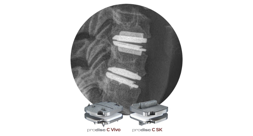 Centinel Spine Wins FDA Nod for 2-Level Disc Replacements